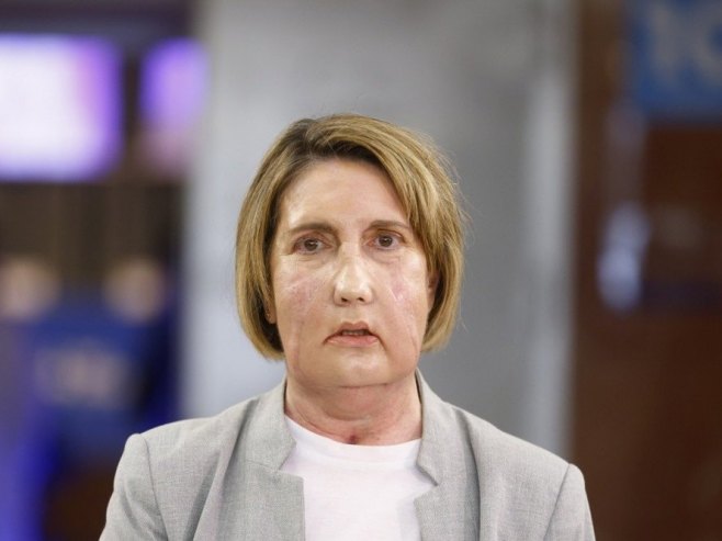 Кармен, прва особа на свијету којој је лице трансплантирано са еутаназираног донора (Фото: EPA/Quique Garcíia) - 